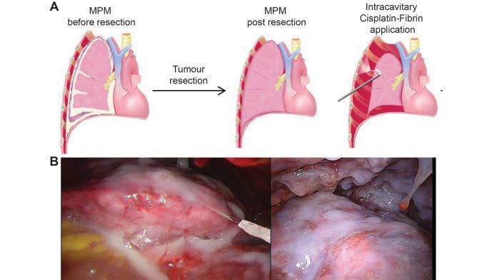 Asbestos The Major Cause of Malignant Mesothelioma