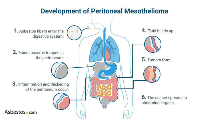 Causes Development and Treatment of Peritoneal Mesothelioma
