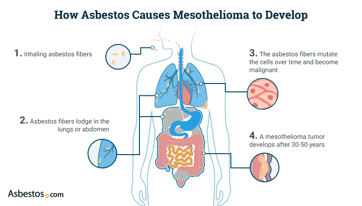 Effective Factors That Leads To Shortness of Breath In Mesothelioma Patients