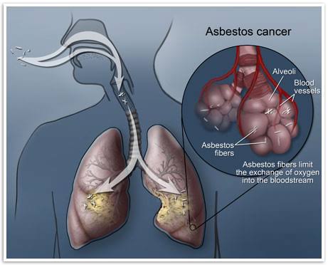 Factors Affecting The Risk of Developing Diseases Related to Asbestos