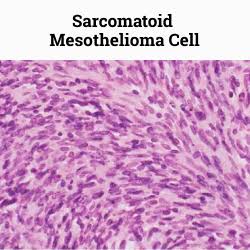 Sarcomatoid Mesothelioma The Most Challenging Type of Cancer